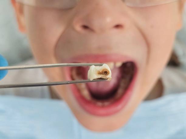 Best Emergency Tooth Extraction in Colonial Pine Hills, SD